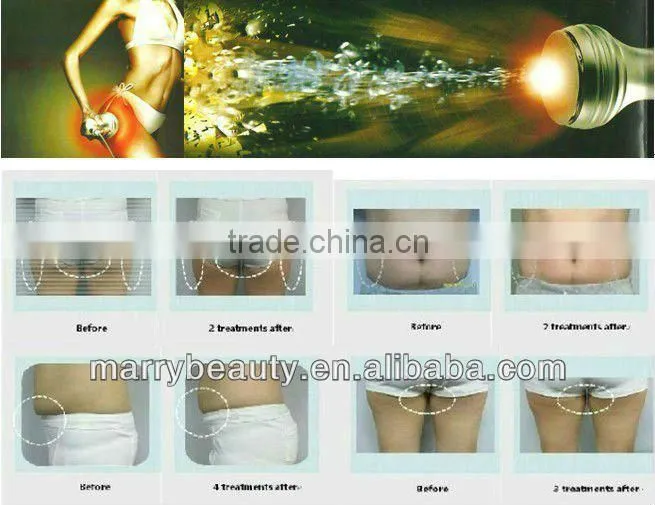 China supplier vacuum cavitation system