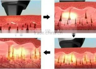 New hotsell salon laser hair removal
