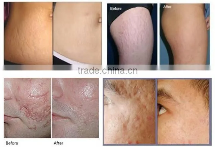 professional skin resurfacing co2 laser