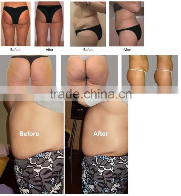 Portable cavitation slimming machine to dissolve redundant fats, loose weight and slim body