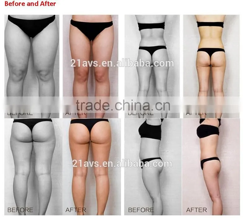 2016 New Liposonix HIFU body slimming weight loss beauty salon equipment