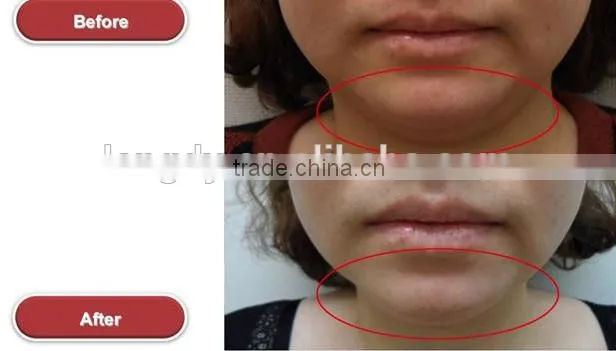 anti ageing machine korea HIFU face lifting LANGDI