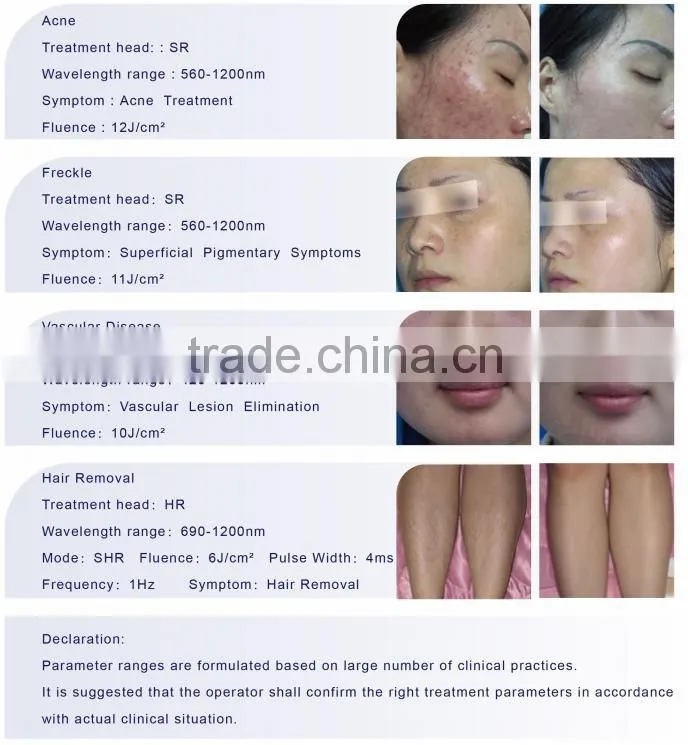 IPL Laser Hair Removal IPL Laser Treatment