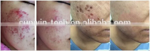 New model co2 facial laser resurfacing