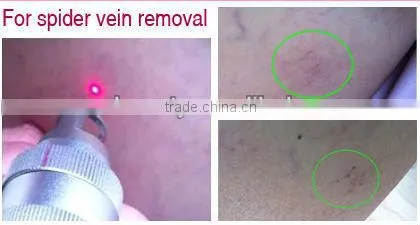 2013 new promotion! stationary hair removal laser yag laser P001