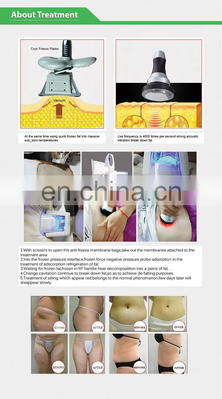 2022 portable double cryo slim 360 degree slimming machine cool fat freezing sculpting machine