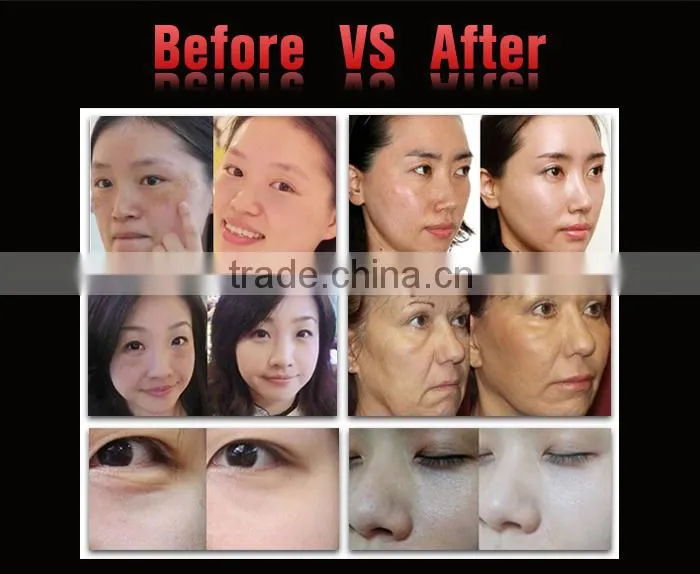 Laptop High Intensity Focused Ultrasound For wrinkle removal