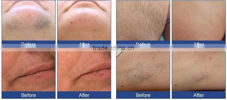 808 diode laser for hair removal with Alex for permanent hair removal