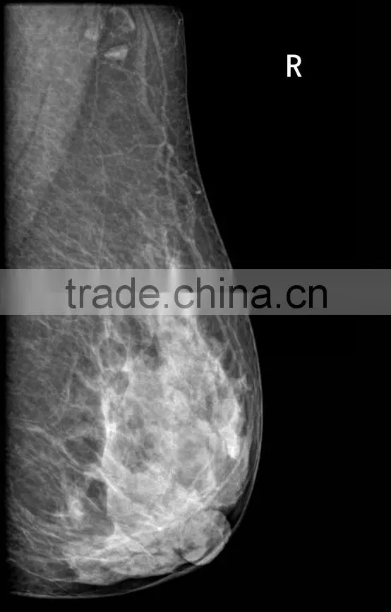Digital Mammography System