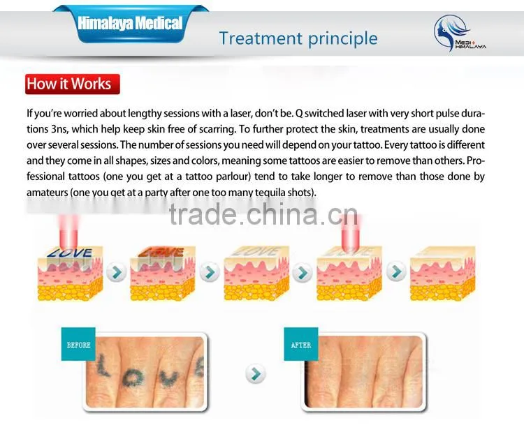 lowest price newest Medical CE Q switch laser acne removal machine