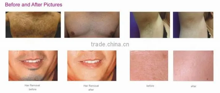 T&B portable 1200W hair removal IPL RF E-light machine
