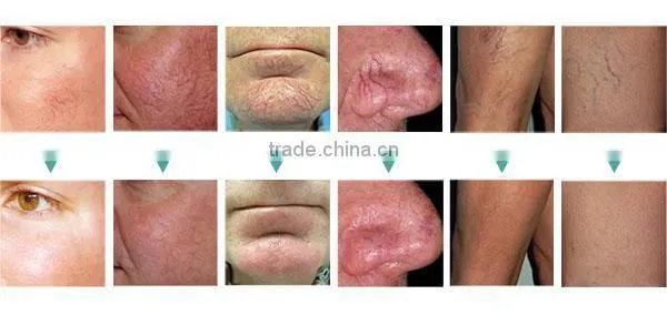 vascular removal spider veins removal