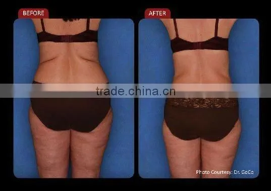 diode lipo laser / Lipo Laser Machine for Slimming