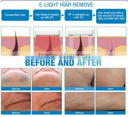 Permanent all body unwanted Hair Remover 808nm diode laser portable equipment