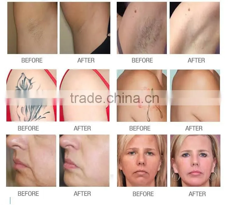 Hot selling elight ipl laser for hair removal