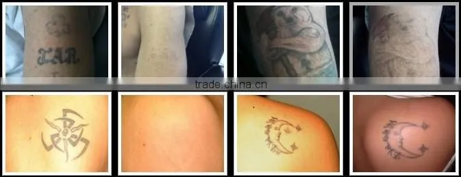 Portable q switched nd yag laser hair and tattoo removal machine low price
