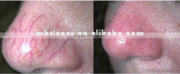Best Quality Made In China 980nm Medical Diode Laser Spider Vein Removal Machine