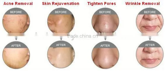 hot sale metal CO2 laser cutting and vaginal tightening and skin rejuvenation machine