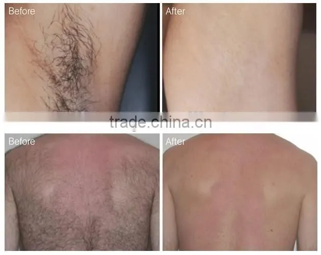 factory price portable 808nm depilation laser for home hair removal machine