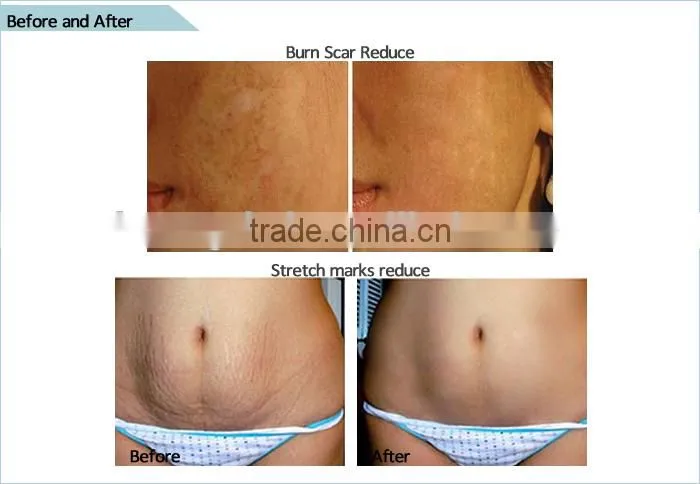 Dermaroller microneedling skin therapy