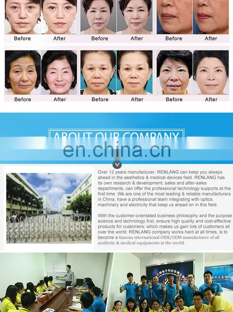 Skin Rejuvenation,Wrinkle Remover,Face Lift Feature and No IPL+ RF rf skin tightening machine