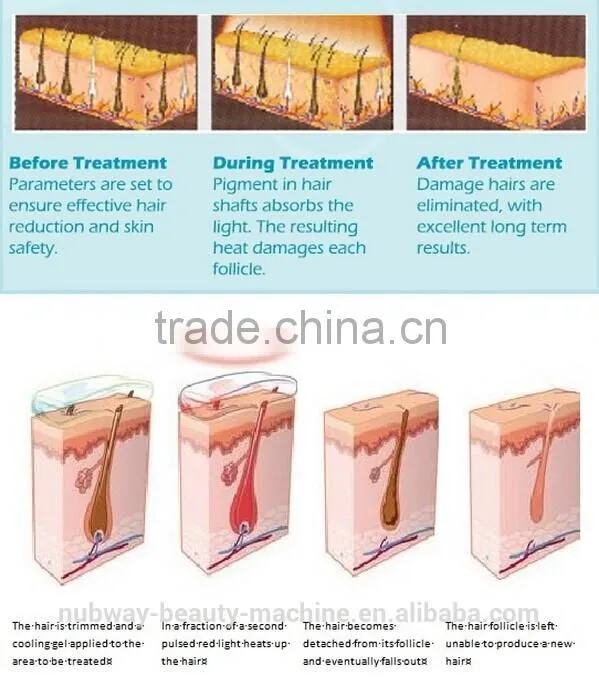 Photo Epilator Facial Rejuvenation Vascular Removal Hair Removal IPL Equipment