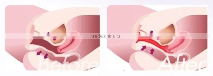 ThinkBig!!!cosmetics manufacturing equipment vaginal tightening stick for beauty salon use