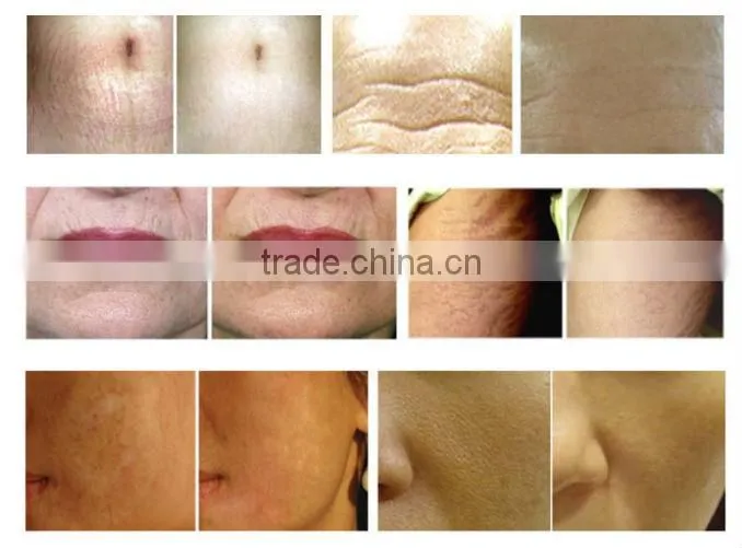 Good one MNS derma roller /professional use derma roller/ON SALES !!!!!!!
