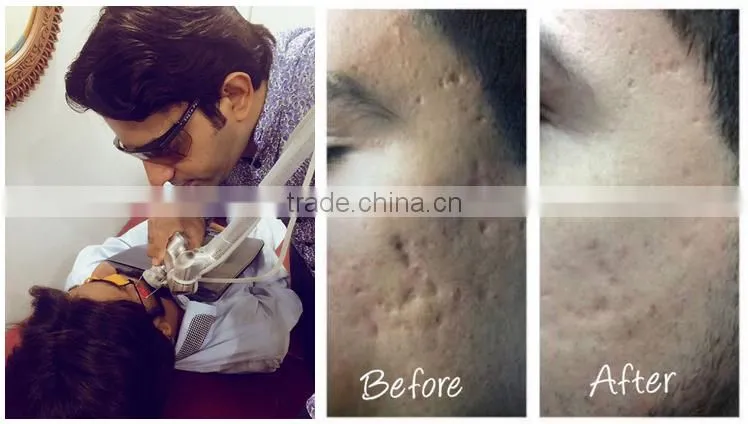 Co2 laser/ co2 Fractional laser/ fractional co2 laser equipment for skin rejuvenation and scar remvoal