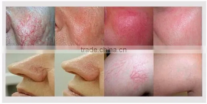 The most popular spider veins removal vascular removal beauty equipment RBS with 30MHZ RF power