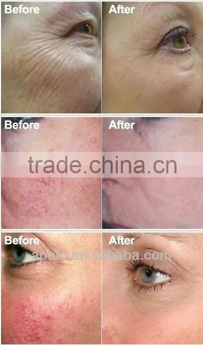photoepilation machine e-light HS 300C photo epilation equipment Ipl Photo Rejuvenation by shanghai med apolo medical technology