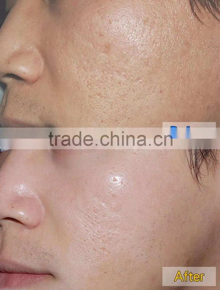 HOT!!! Portable Diamond Microdermabrasion Machine for Skin Rejuvenation