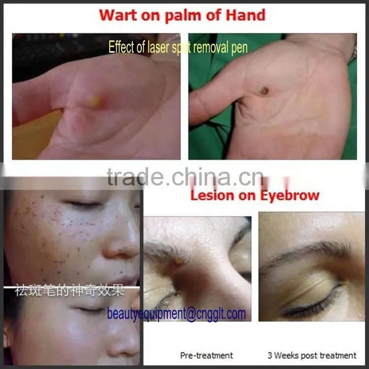 Promotion laser spot removal pen freckle mole