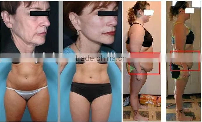 Latest cavitation RF shock wave best slimming products