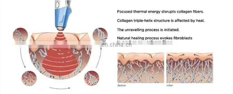 2 in 1 Vacuum cavitation system fat cutting Ultrasound RF weight loss machine