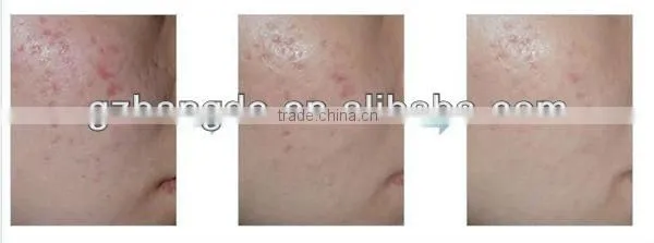 DNS new design photon electric roller micro needle beauty machine---skin maintenance microneedle nurse system BD-WZ006