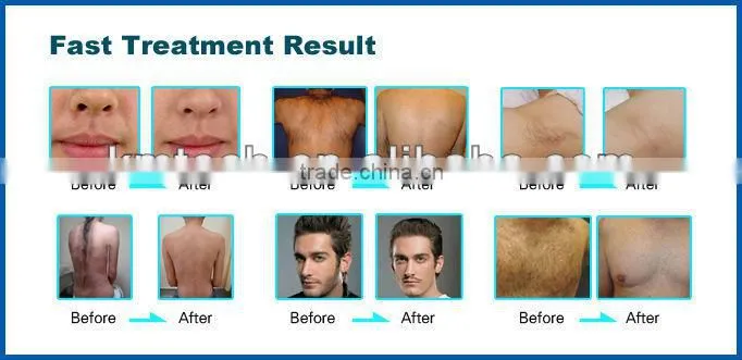 The newest !! rf ipl skin care with hot promotion