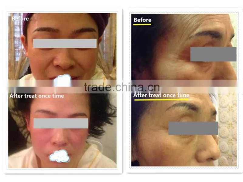 NL-TM800 2015 BEST! fractional microneedle mesotherapy machine for sale (CE)