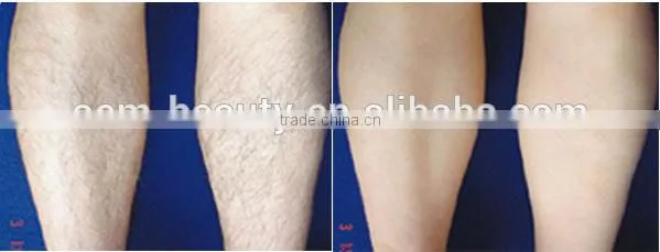 Perfect nd yag laser professional remove hair safe to dark skin