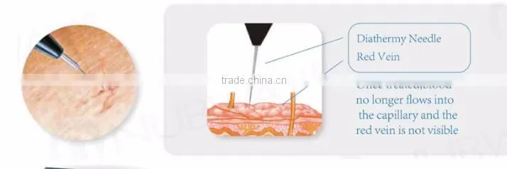 The most popular spider veins removal vascular removal beauty equipment RBS with 30MHZ RF power