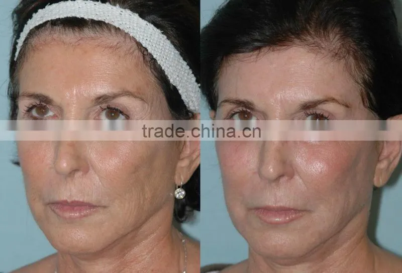 40W China most Professional rf fractional laser co2 burn debridement treatment