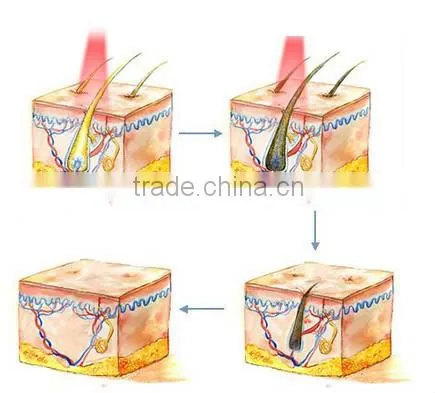 Hot sale IPL hair removal and skin rejuvenation machine/device! 755nm diode laser with TUV certificated ICE2