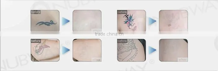 Newest Tattoo Removal Machine Q Switched laser nd yag long pulse