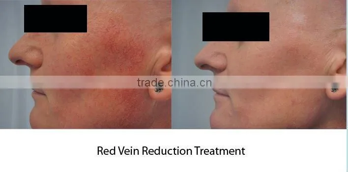 IPL RF Laser Beauty Device