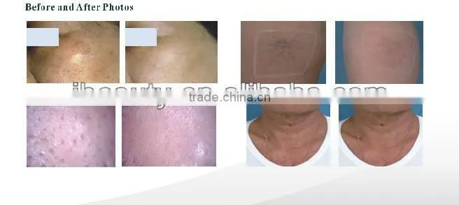 ipl rf nd yag laser hair removal machine/elight with ce/home use ipl