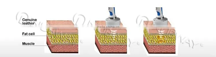 2016 new inventions hifu ultrasonic liposuction cavitation / hifu slimming machine