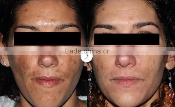 High power co2 laser vaginal rejuvenation treatment beauty vaginal beauty machine