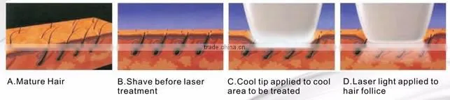 Deep color hair removal 808nm diode laser