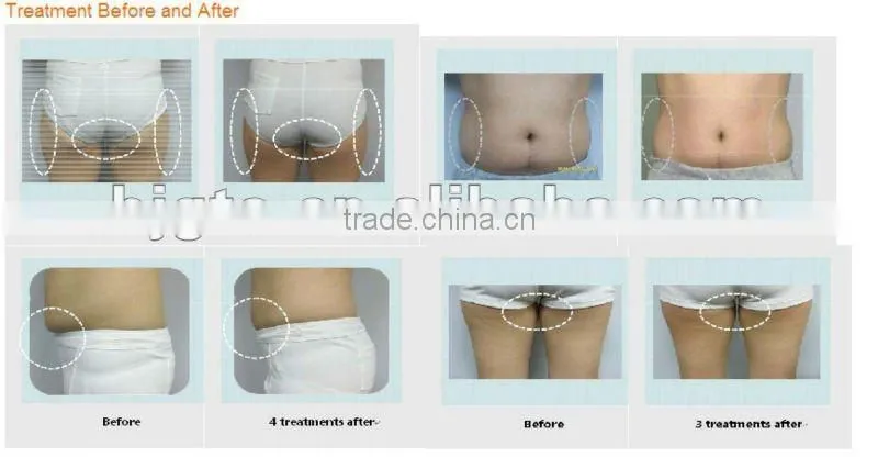 On sales 2013 Newest Lipo laser slimming machine