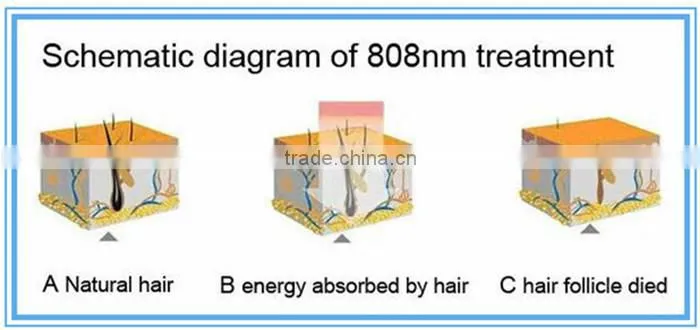 high power 808nm hair removal machine diode laser